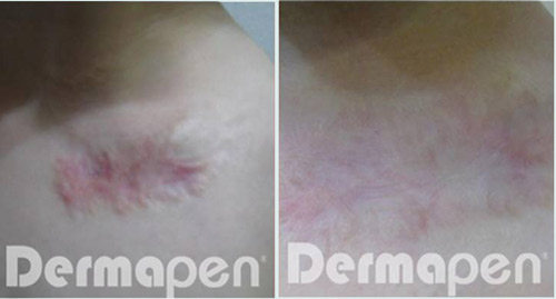 before-after-dermapen-4