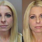 A woman's face before and after liposuction in Las Vegas.