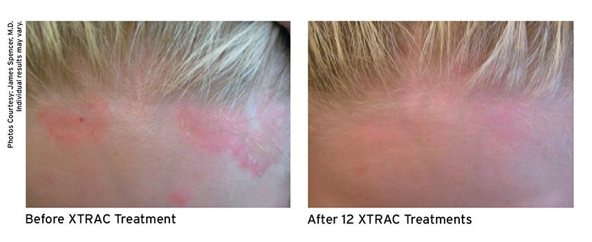 Before and after XTRAC treatment.